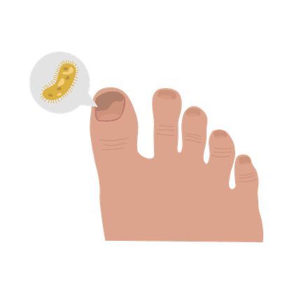 甲真菌病（甲癣）和足真菌病（香港脚）